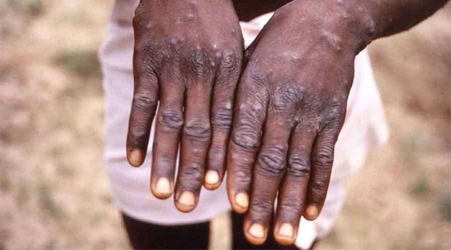 Monkeypox-2022-06-01